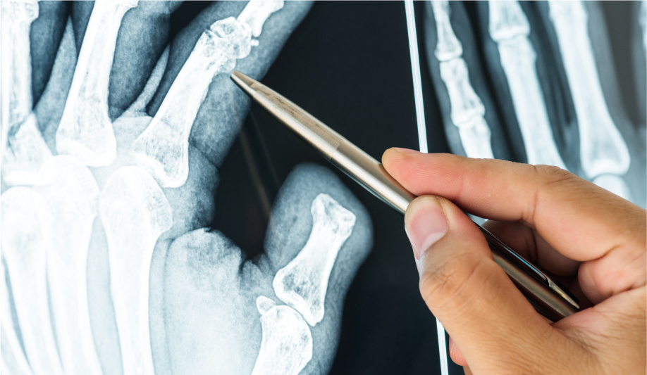 lesionesgravesfracturas rdi 02