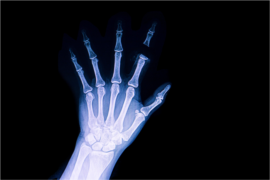 lesionesgravesamputacion rdi 02